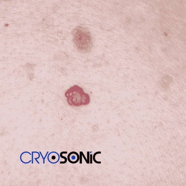 Looking for pain free cherry angioma removal treatment Banbury? Call our team today! Banbury