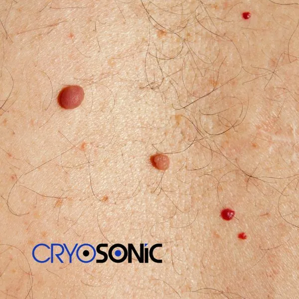 get cherry angioma removal treatment today! Banbury