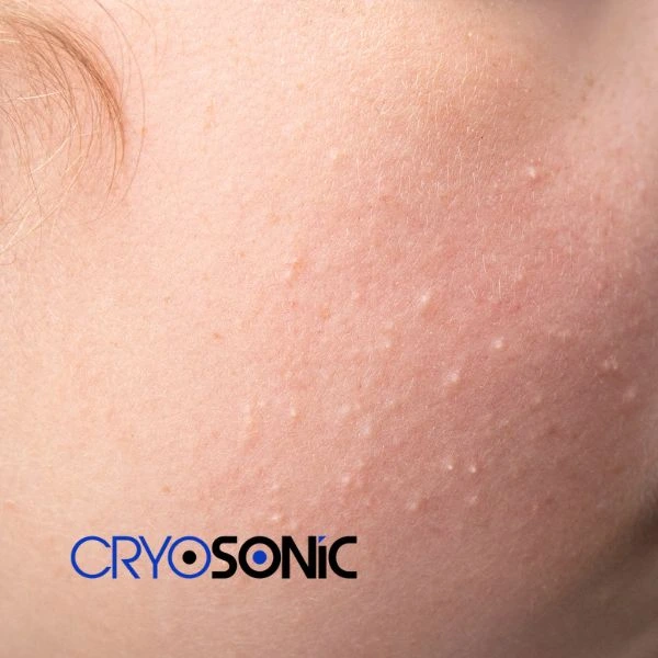 Are you looking for milia removal treatment? Contact our team today Banbury