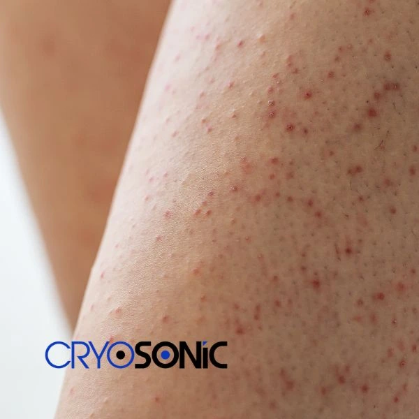 Looking for Seborrhoeic Keratosis removal Banbury treatment? Call our consultants today in Banbury