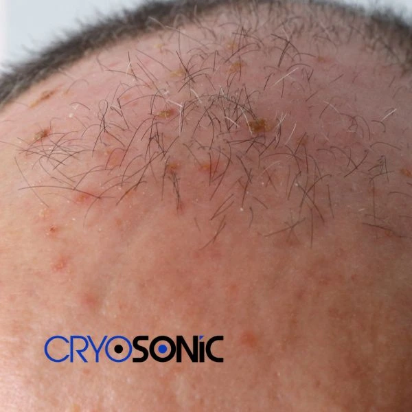 Access Seborrhoeic Keratosis removal from the comfort of your own home! Call us today in Banbury