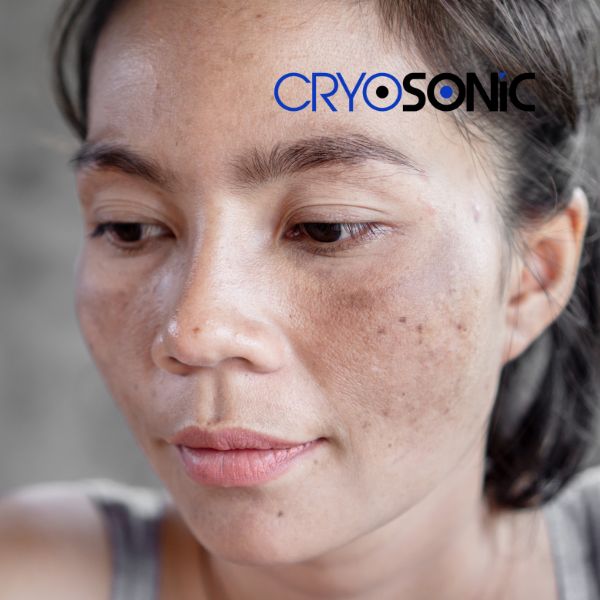 Ready to start age spots removal? Contact our team today in Banbury