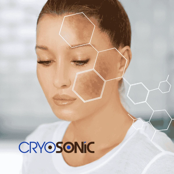 Are you looking for age spot removal treatment? Contact Cryosonic today in Banbury