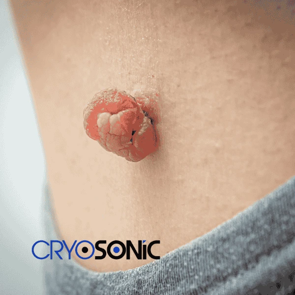 Book your skin tags removal Banbury from comfort of your own home! Banbury