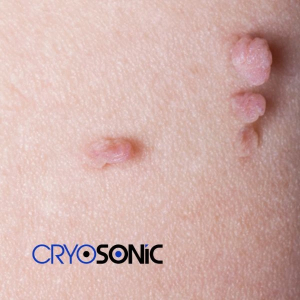Are you looking for fast effect skin tag removal Banbury? Book in NOW! Banbury