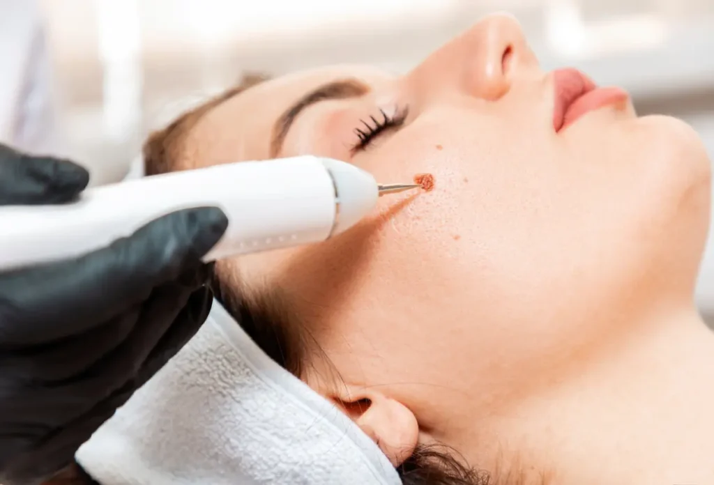 CryoPen Accuracy Banbury being used to safely and precisely remove multiple skin lesions, illustrating answers to common patient FAQs Banbury