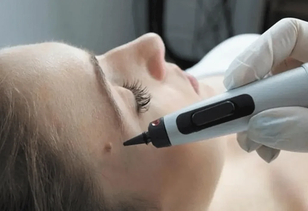 CryoPen accurately targeting skin lesions with millimetre-precision for safe and effective removal by Cryosonic Banbury