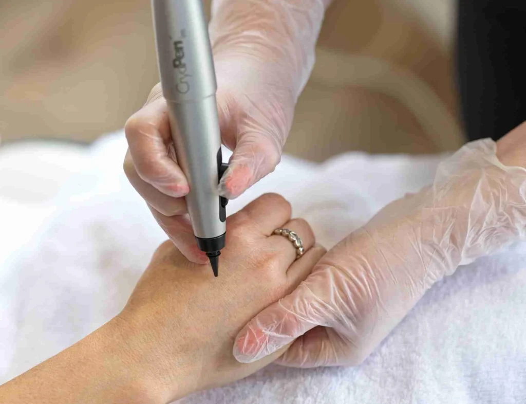 CryoPen Accuracy Banbury in action, precisely targeting a skin lesion to ensure safe treatment and protect surrounding healthy skin Banbury