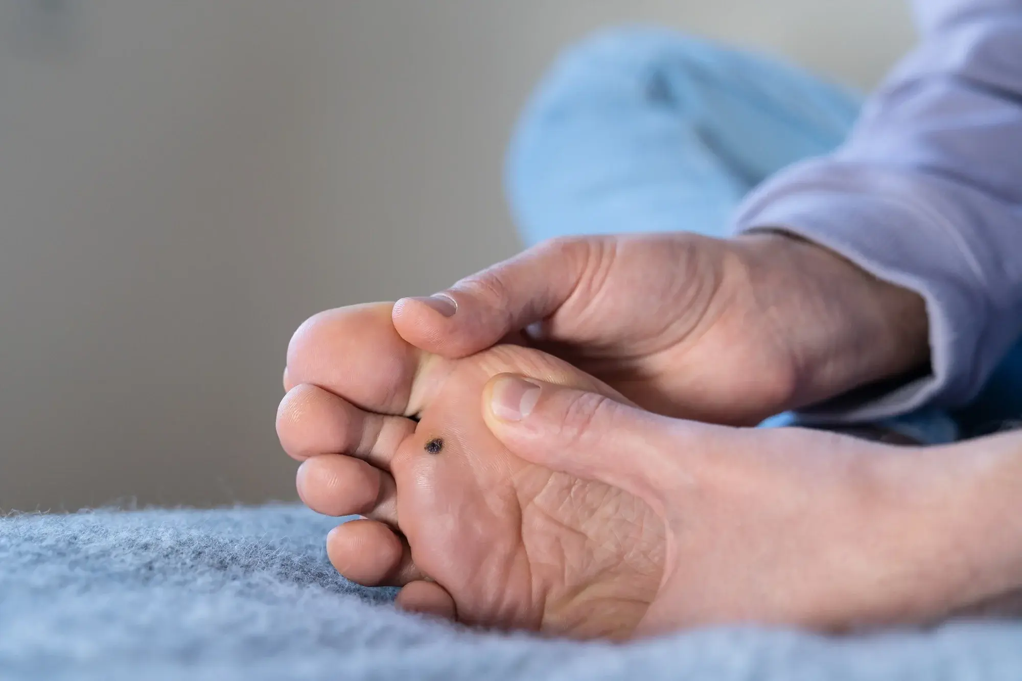 CryoPen treatment for multiple and stubborn Plantar Warts (Verrucae) Banbury, showing safe, precise removal and patient-friendly procedure Banbury