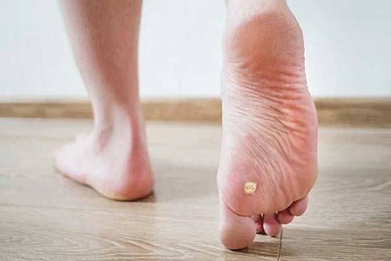 CryoPen treatment removing stubborn Plantar Warts (Verrucae) for precise, safe, and effective relief from resistant lesions Banbury