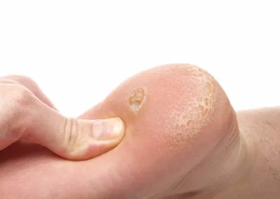 Painful Plantar Warts (Verrucae) Banbury, highlighting how stubborn warts affect everyday activities and comfort Banbury