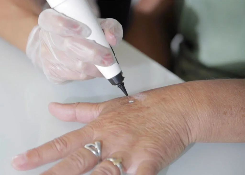 Close-up of CryoPen accuracy Banbury targeting a skin lesion, showing why precision matters for safe and effective removal Banbury