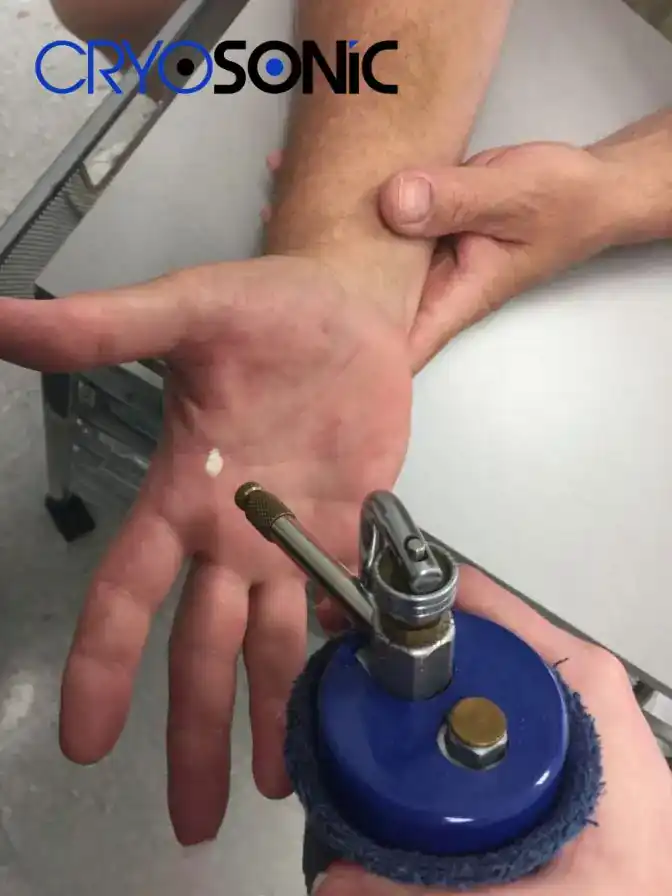 Temperature Differences: OTC vs Medical-Grade Cryotherapy Banbury